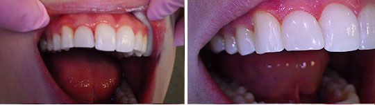 Patient 1, composite veneers photo 2